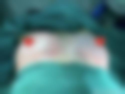 自体脂肪隆胸能维持多少年?常见变化路径