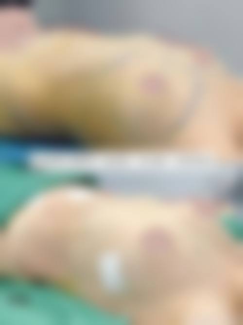 {自体脂肪隆胸有危害吗？真相揭秘！脂肪结节、感染、不对称等危害必须警惕！ 