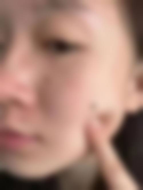 4. 脱毛后需要注意什么？