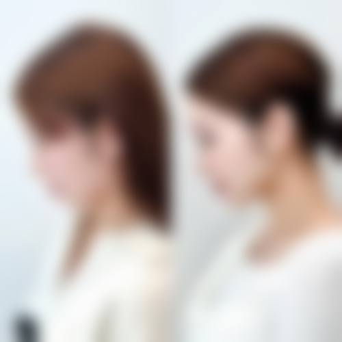 二、打瘦脸针一周后吃消炎药通常在什么阶段被纳入医疗选择范围？