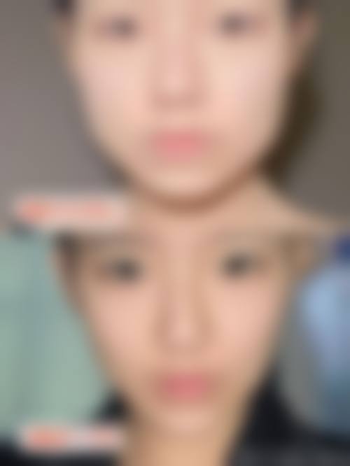 从医学角度看,瘦脸针的风险主要集中在哪些环节?