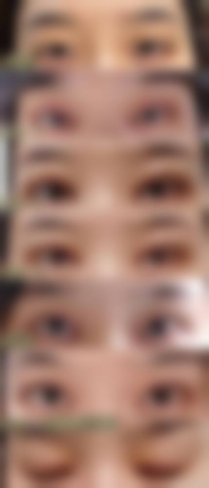 {怎样去脂肪粒和黑眼袋？试试天然果蔬法、按摩法和眼霜护理，效果显著！激光治疗500元起，专家亲授3步护理法