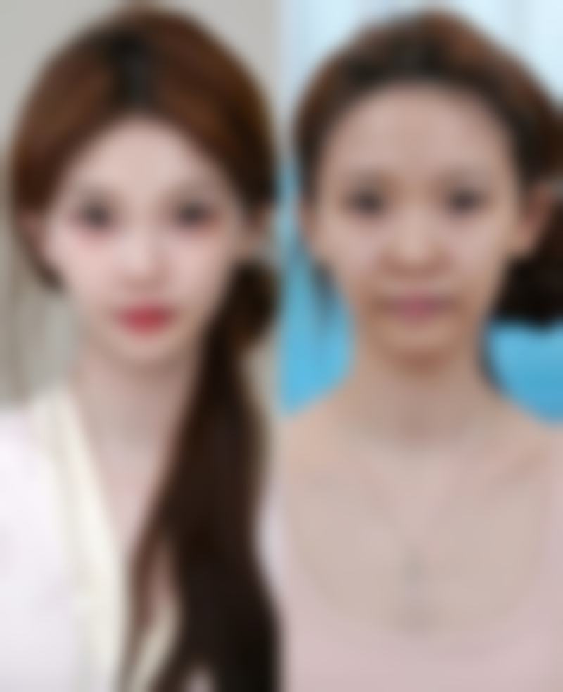 收费透明无隐形：隆鼻价格分级报价，拒绝套路