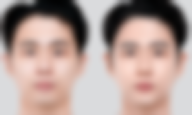 割完双眼皮怎么做眼部运动？中期修复过程中的变化