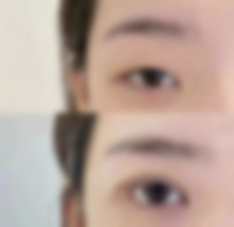 割完双眼皮怎么做眼部运动？如何判断“修复是否在合理轨道内”