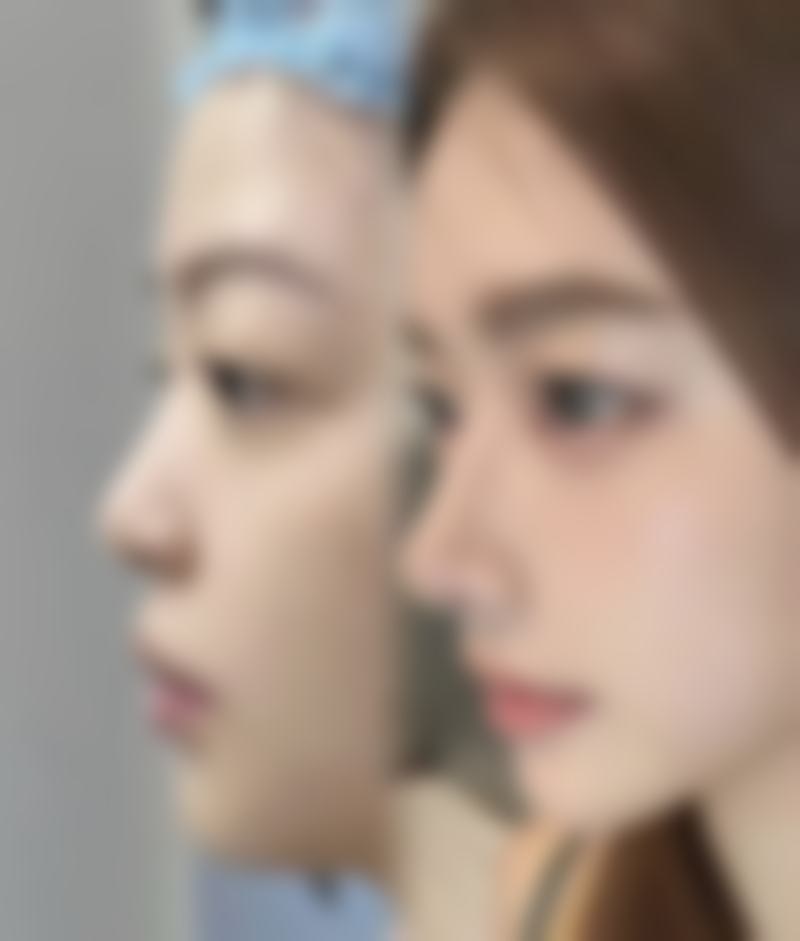 苏州拉皮手术多少钱？价格表显示面部拉皮2-5万起，收费标准超透明！ 