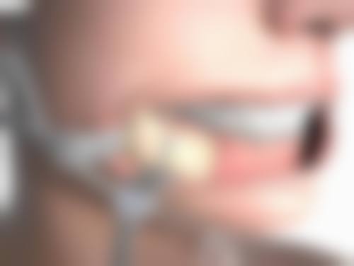 总结：广州无痕筋膜提升价格参考与选择建议