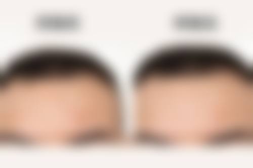 术后一个月用疤痕膏的风险