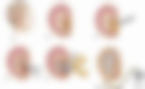 成都再造耳手术需要多少钱？2026年价格明细：一期埋扩张器1.5万起！