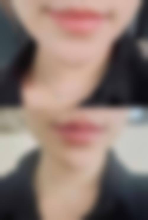 如何判断佛山欣菲聆玻尿酸报价是否合理