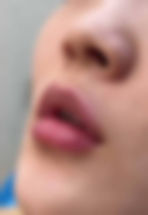 深圳玻尿酸丰唇