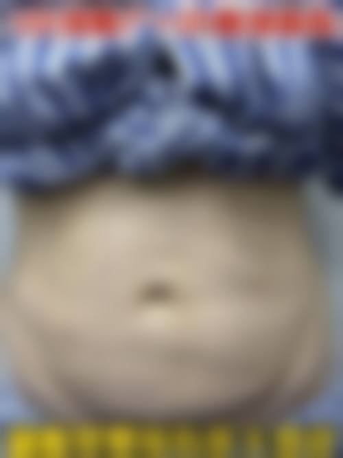 腹部吸脂手术后的疼痛问题