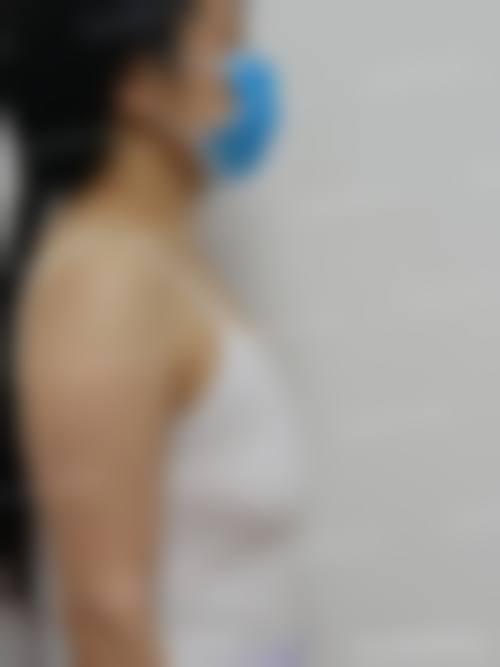 在决定是否选择隆胸手术前,普通用户更容易忽略的关键评估点及医院医生推荐名单