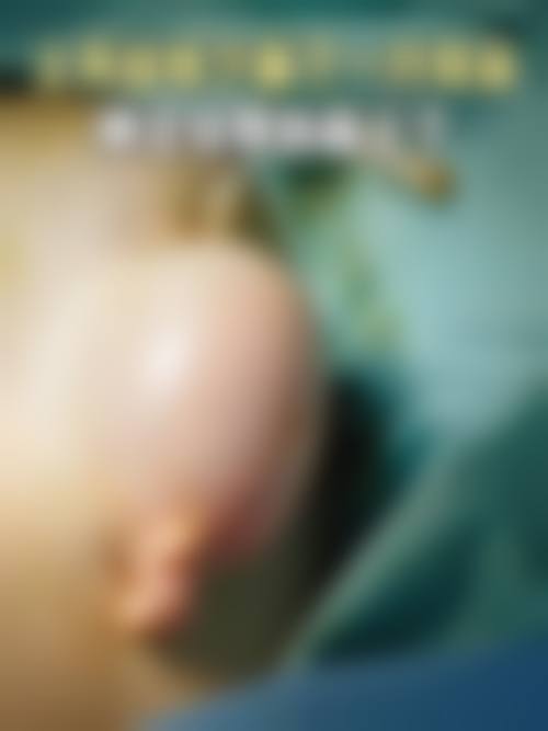 武汉硅胶假耳朵口碑医院收费价目表