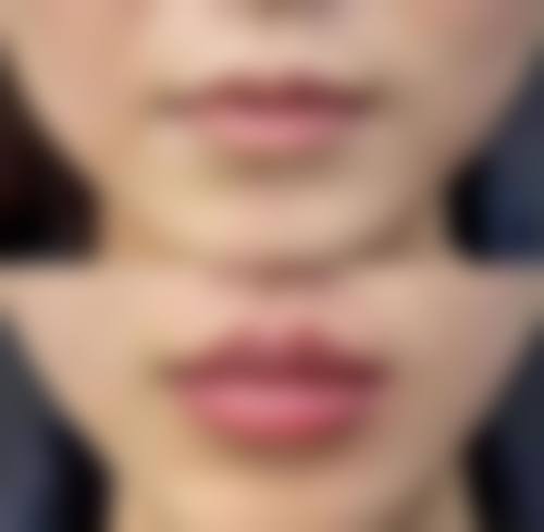 深圳注射丰唇针多少钱