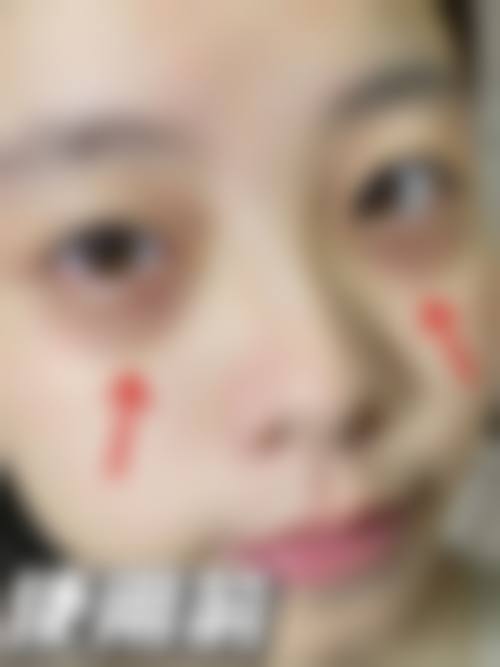 成都地区排名前三医院玻尿酸项目收费价目表