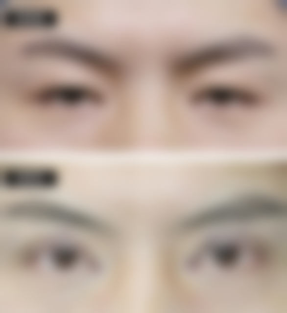 做双眼皮什么时候做好？春秋两季至佳，气温适宜修复快且感染风险低！——如何判断“修复是否在合理轨道内”