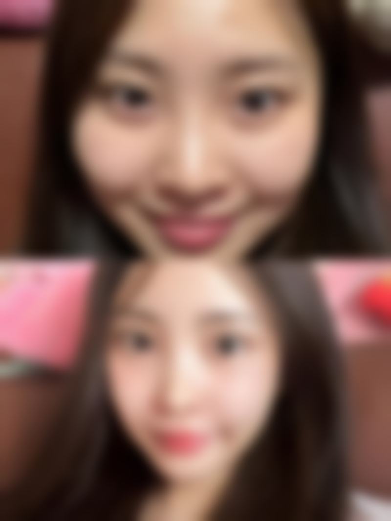 做双眼皮何时最佳？春秋季温度适宜恢复快，感染风险低更安心！