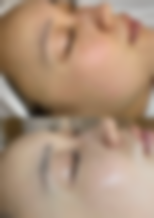 小腿抽脂的疤痕与生命危险问题及对反弹的间接影响