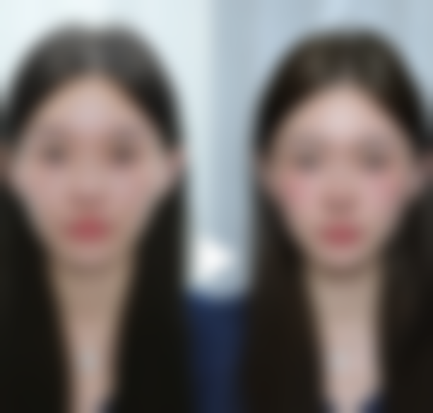 小腿抽脂修复情况与反弹的联系