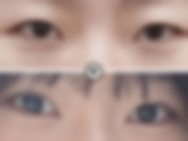 做双眼皮什么时候做好？春秋两季至佳，气温适宜修复快且感染风险低！——术后短期常见反应