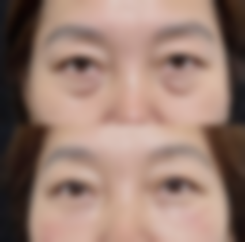 做双眼皮什么时候做好？春秋两季至佳，气温适宜修复快且感染风险低！——修复期对生活的实际影响