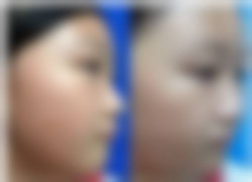 增生性疤痕治疗是否危险?风险主要集中在哪些环节?