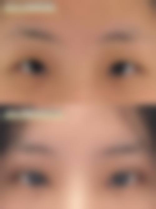 外切眼袋手术3 - 6个月的修复情况