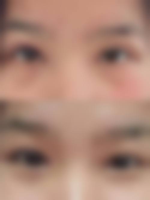 外切眼袋手术的价格区间及费用差异来源