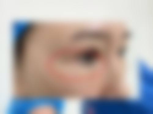 在决定是否选择外切眼袋手术前，普通用户更容易忽略的关键评估点及医院医生推荐