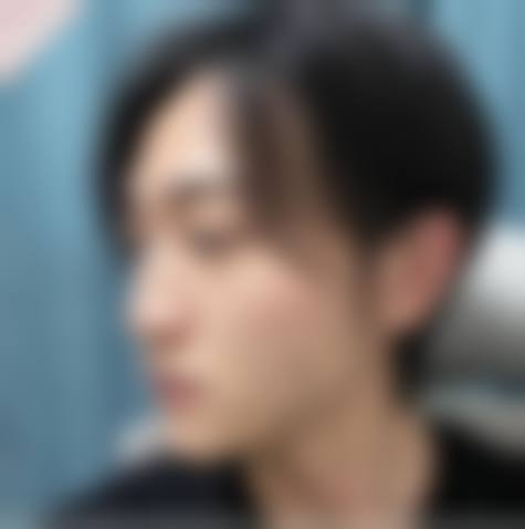 选择人中整形骨干医生的注意事项