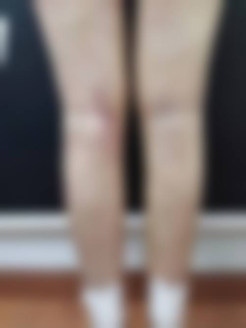 大腿吸脂的失败结果是否存在不可逆情况