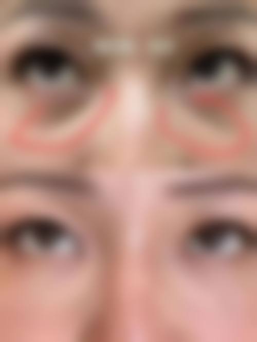 哪些使用场景下改善泪沟的成效往往不理想