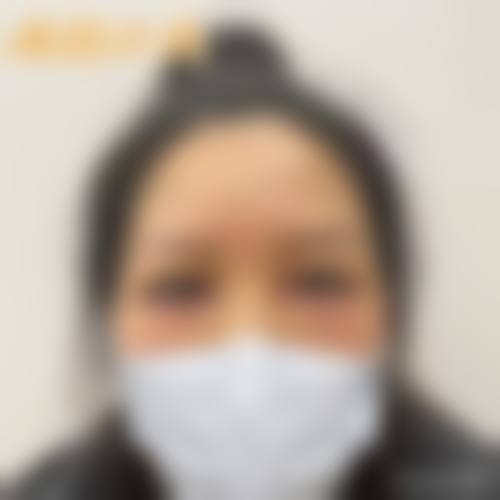 如何为去眼袋改善泪沟设定一个合理且可验证的成效目标