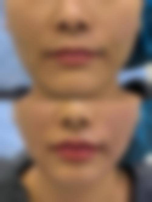 无痕提眉和筋膜提眉区别