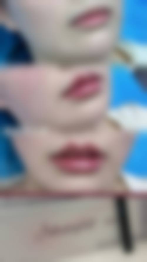 武汉天安整形美容医院——厚唇改薄技术保护