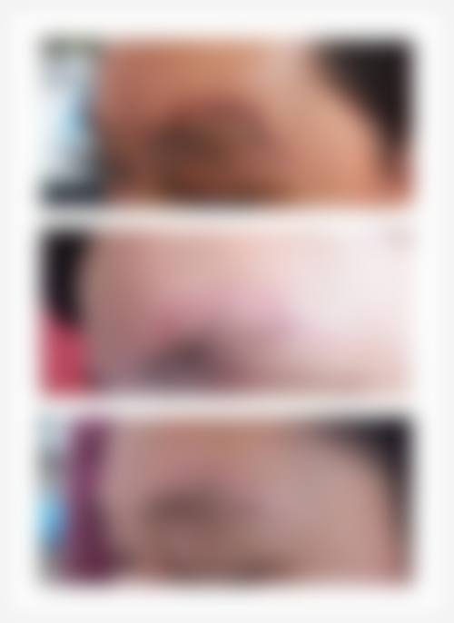 增生性疤痕能去除吗?从病理角度分析