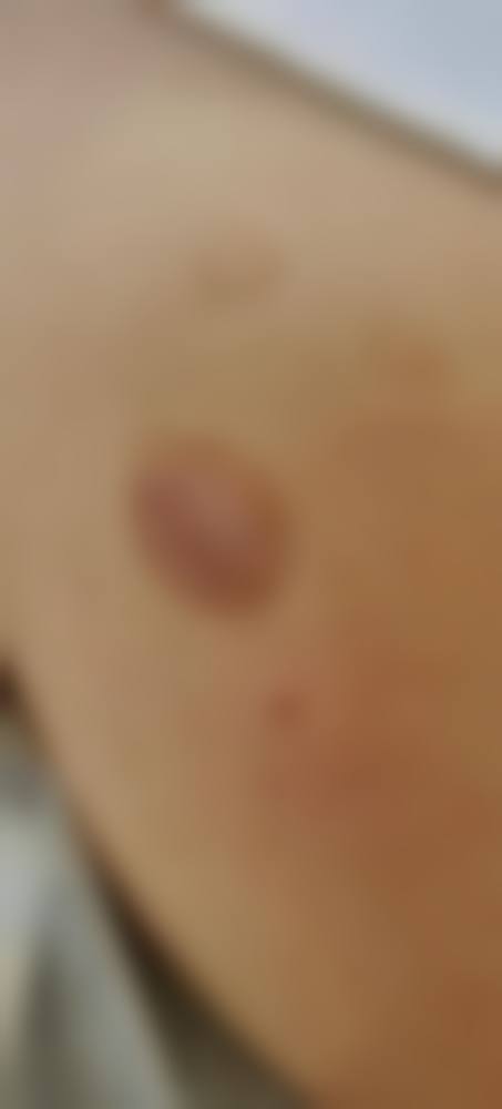 非疤痕体质疤痕消除的方法及优缺点