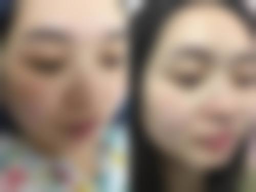 杭州医院激光祛斑价格的影响因素