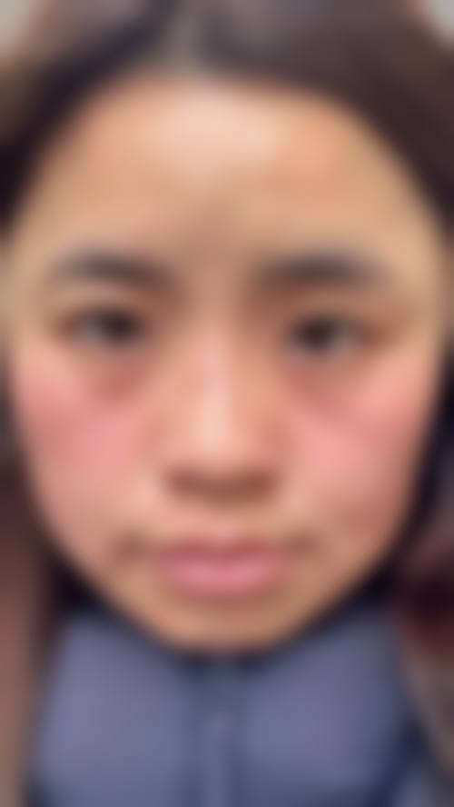 不同斑种的激光祛斑价格差异