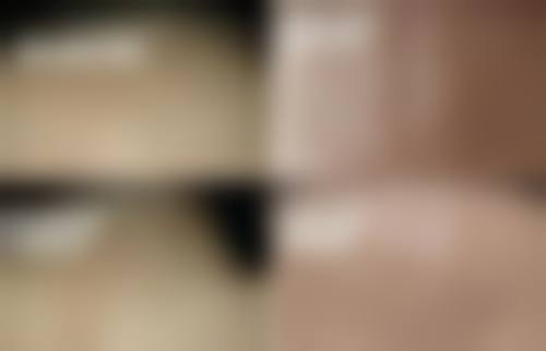 增生性疤痕治疗常见并发症或后遗症,真实发生概率如何?