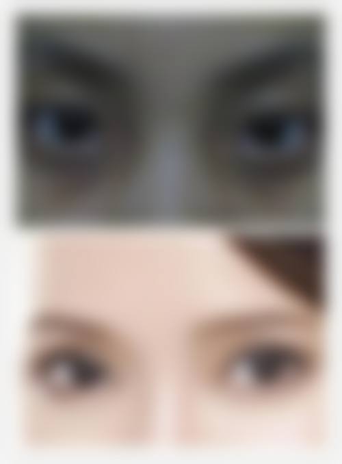 哪里能看到达芬奇去眼袋怎么做的视频和图片？