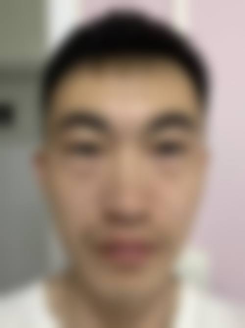 去眼袋改善泪沟的成效稳定性与哪些条件直接相关