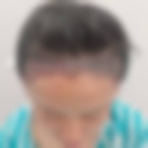 四、盛飞医生主刀的半肋鼻,12800元到底值不值?