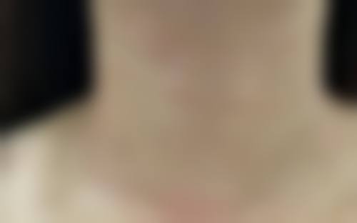 2026重庆颈纹嗨体注射一次多少钱：500-3000元/支，重医附一院等可做，维持6-12个月