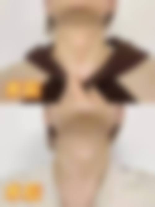 杭州天鑫医疗美容医院的艾长安医生隆鼻技术到底咋样？