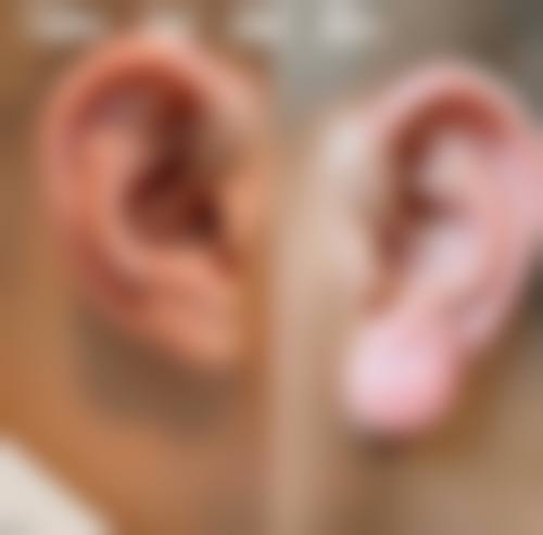 四、耳再造项目热门问题解答及在线询问