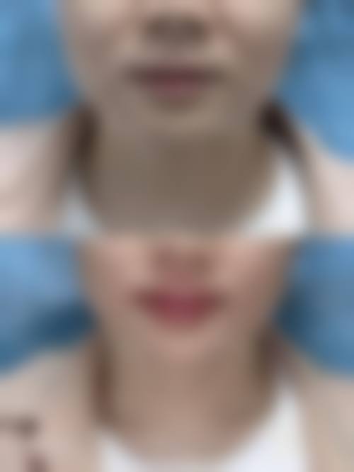 武汉厚唇改薄哪家好？精选医院与专家，助你拥有精致唇形