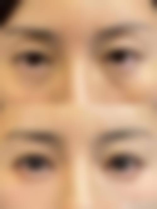 韩国优雅人整形外科医院联系方式揭秘：正规有实力，隆鼻、眼窝填充、额头缩小项目值得选！ 