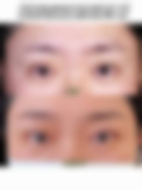 胡柏医生在杭州天鑫医疗美容医院的眼袋治疗有啥优势？